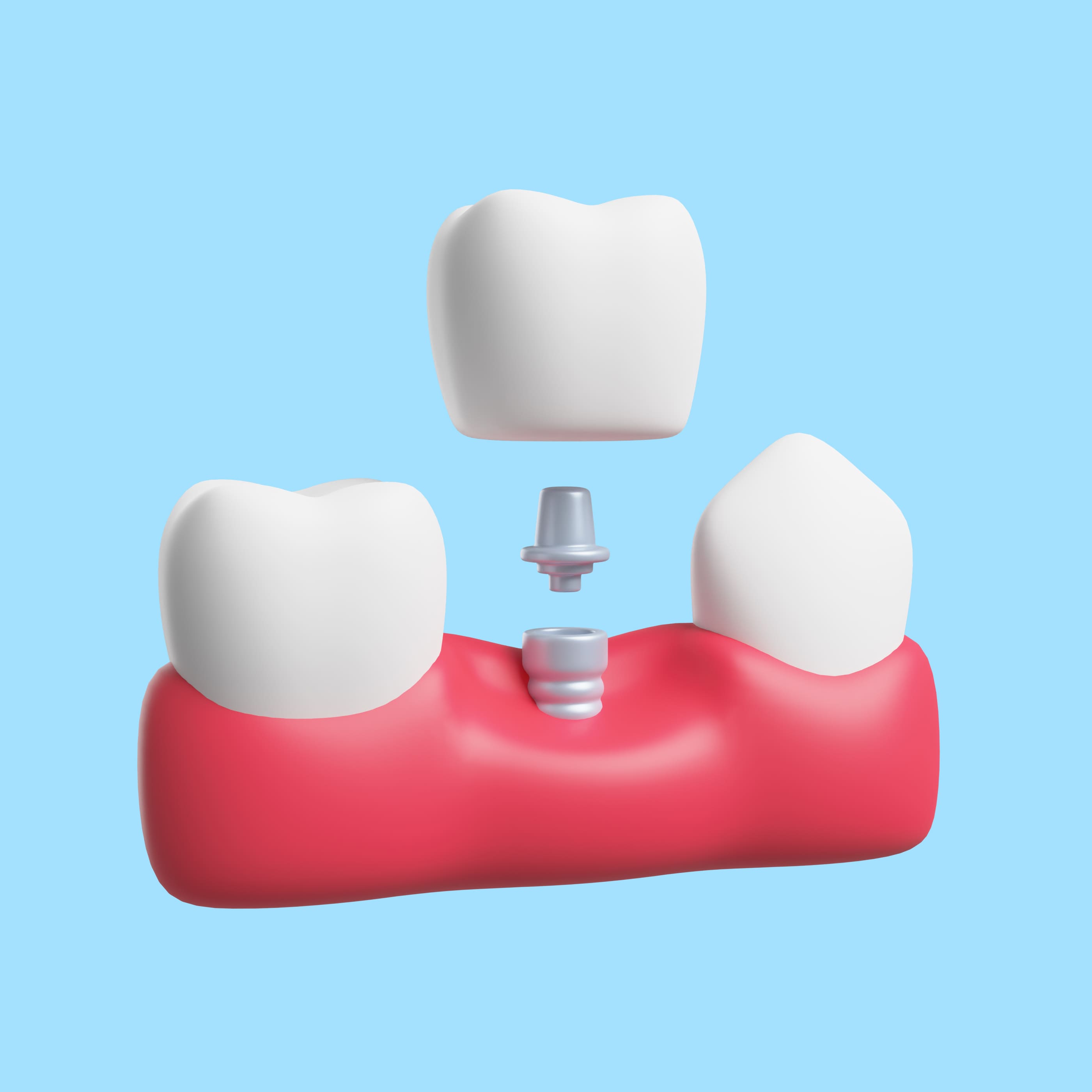 Одноэтапная имплантация зубов 1